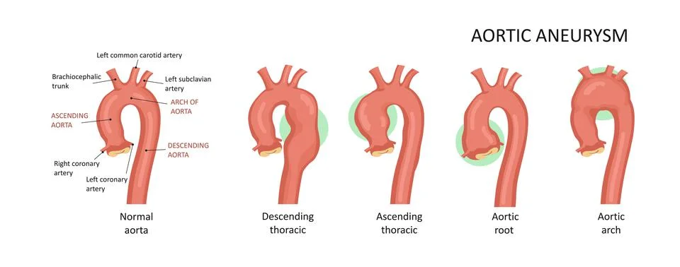 Types of aortic aneurysms: root, ascending, descending,arch. Stock Illustration