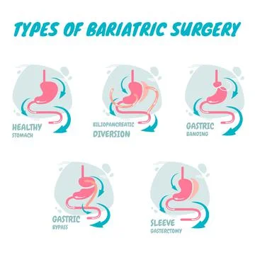 Types of bariatric surgery, it is process for the digestive system in stomach, A Stock Illustration