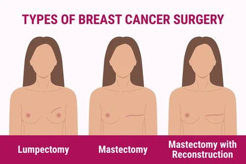 What Are The Different Types of Breast Cancer Surgeries?