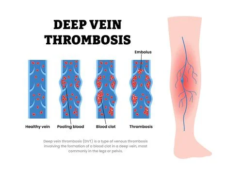 Types of deep vein thrombosis type with normal vein, pooling blood, blood c.. Stock Illustration