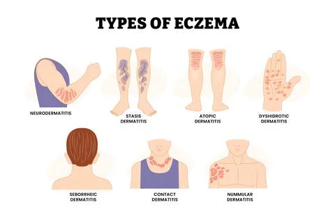 Types of Dermatitis or Eczema Types Itchy, Inflamed Skin, Dermatology, Educ.. 库存插图