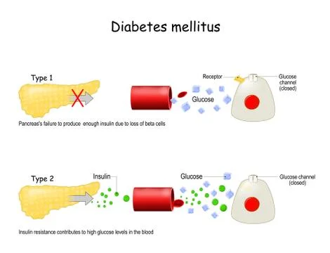 Types of diabetes mellitus. Illustrazione stock