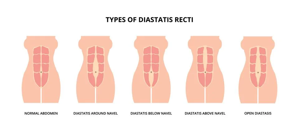 Types of diastasis recti Illustrazione stock