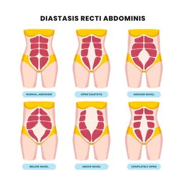 Types of diastasis recti poster scheme, medical education banner, abdominal.. Stock Illustration