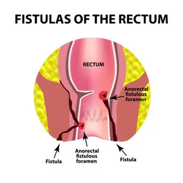 Types of fistulas of the rectum. Paraproctitis. Anus. Abscess of the rectum Stock Illustration