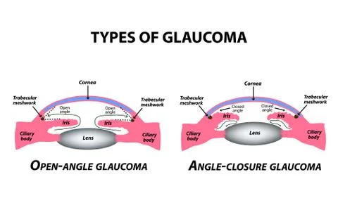 Types of glaucoma. Open-angle and angle-closure glaucoma. The anatomical Stock Illustration