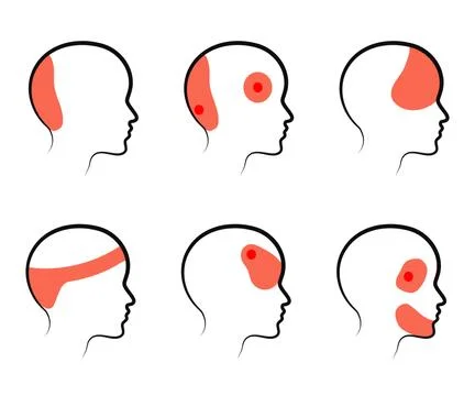 Types of headaches on a white background. Silhouette. Stock Illustration