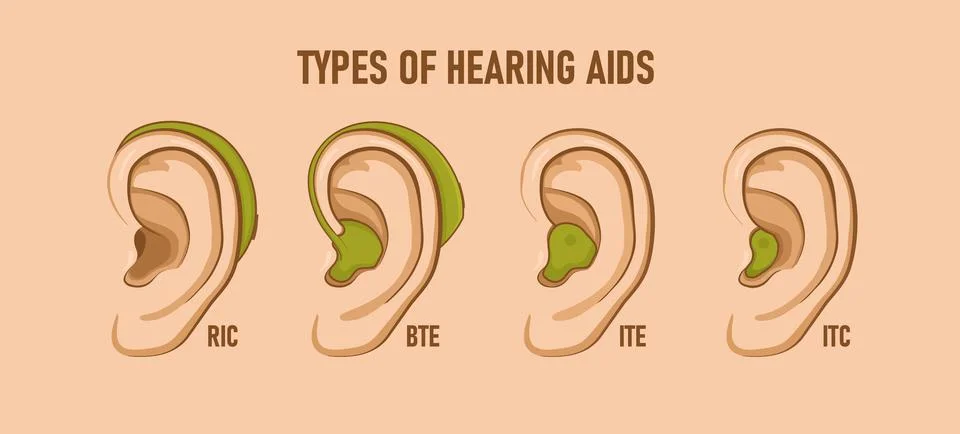 Types of hearing aids. Vector illustration Stock Illustration