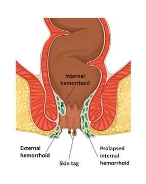 Types of hemorrhoids. Stock Illustration
