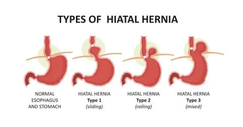 Types of hiatal hernia Stock Illustration
