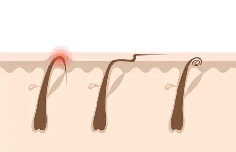 Types of ingrown hairs Illustrazione stock