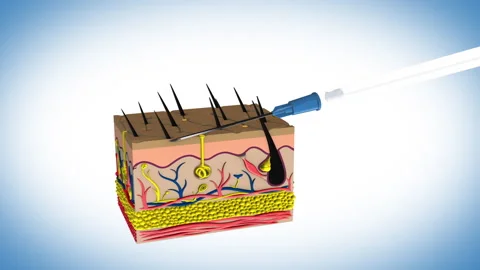 Types of Injections - 10 -15 degrees Intradermal bis Stock Footage 259094104