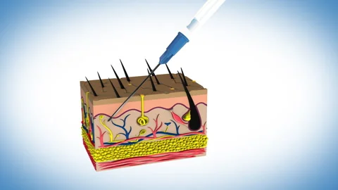 Types of Injections - 45 degrees Subcutaneous Stock Footage 259094105