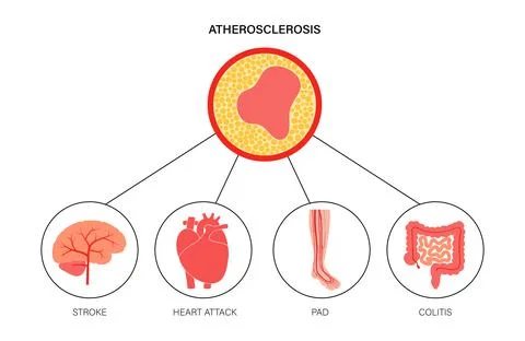 Types of ishemia Stock Illustration