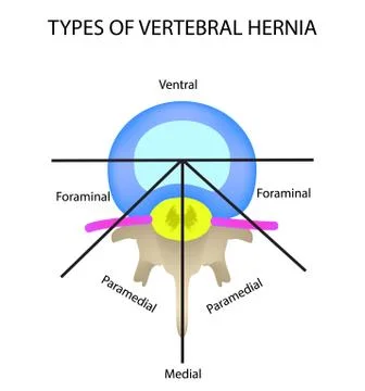 Types of location of the intervertebral hernia. Vector illustration on isolated Stock Illustration