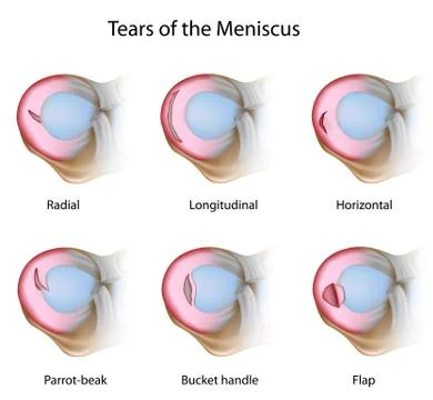 Types of meniscus tears Stock Illustration