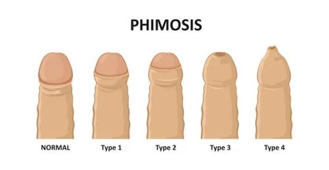 Types of phimosis. Vector illustration Stock Illustration