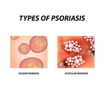 Types of psoriasis. Not pustular and pustular psoriasis. Eczema, skin disease Stock Illustration