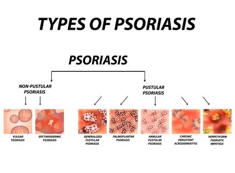 Types of psoriasis. Pustular and not pustular. Vulgar, erythroderma Stock Illustration