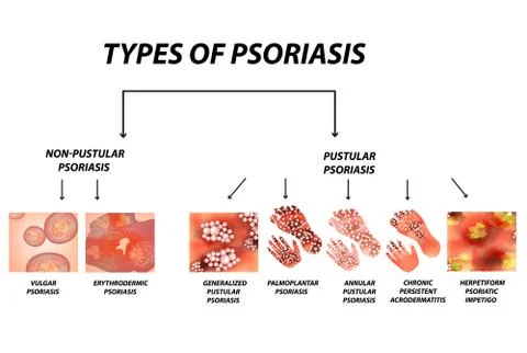 Types of psoriasis. Pustular and not pustular. Vulgar, erythroderma Stock Illustration