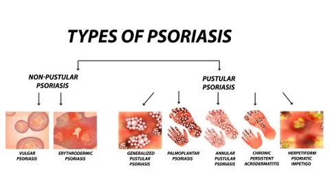 Types of psoriasis. Pustular and not pustular. Vulgar, erythroderma Stock Illustration