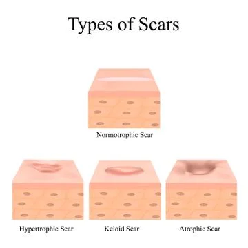 Types of scars. Acne scars. Keloid, hypertrophic, atrophic, normotrophic. The Stock Illustration