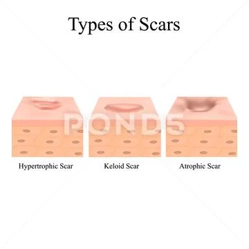 Types of scars. Acne scars. Keloid, hypertrophic, atrophic ...