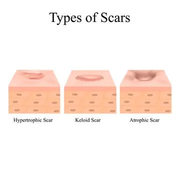 Types of scars. Acne scars. Keloid, hypertrophic, atrophic, normotrophic. The Stock Illustration