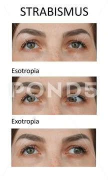 Types of Strabismus. Esotropia and exotropia Stock Photos