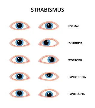 Types of strabismus Illustrazione stock