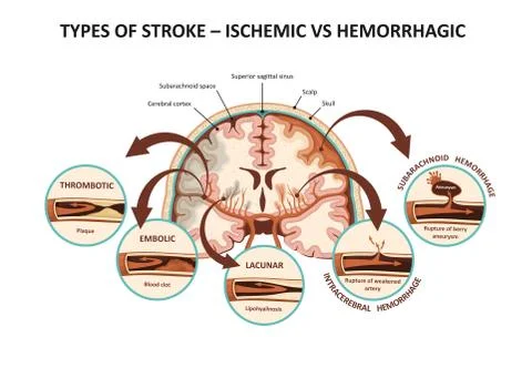 Types of stroke – ischemic vs hemorrhagic Stock Illustration