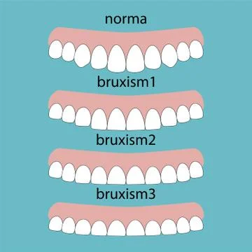 Types of teeth erasability. Layout attrition Bruxism teeth illustration vecto Stock Illustration