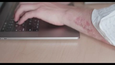 Typing a emal with psoriasis Stock Footage 135897454