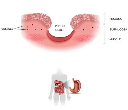 Ulcer Stock Illustration