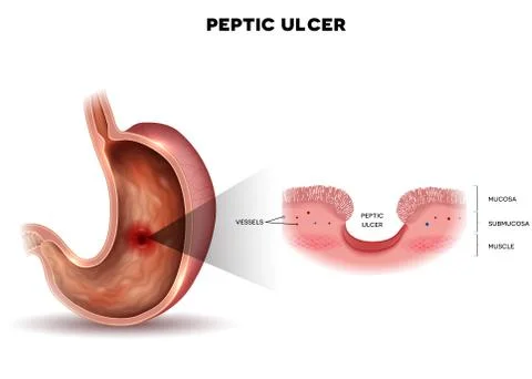 Ulcer of the stomach Stock Illustration