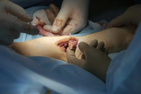 Ulna Bone Section During Surgery Фото