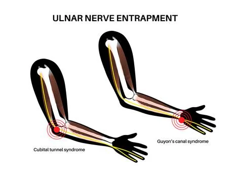 Ulnar nerve entrapment Stock Illustration