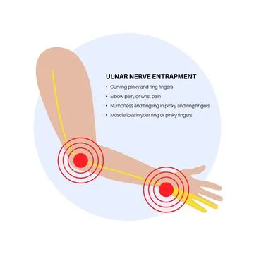 Ulnar nerve entrapment Stock Illustration
