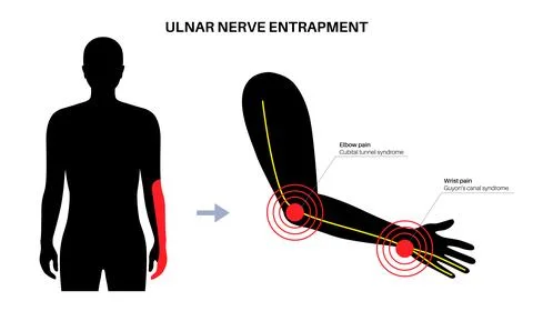 Ulnar nerve entrapment Stock Illustration