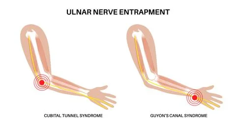 Ulnar nerve entrapment Illustrazione stock