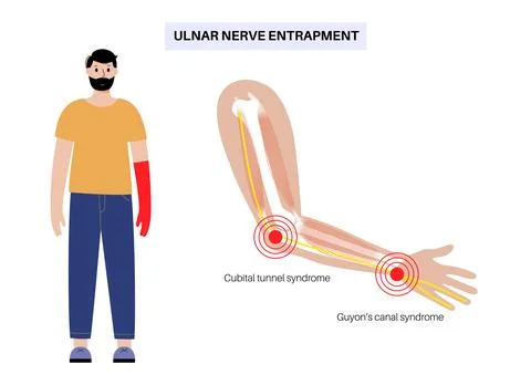 Ulnar nerve entrapment Stock Illustration