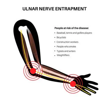 Ulnar nerve entrapment Stock Illustration
