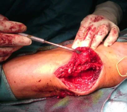 Ulnar nerve surgery Foto stock