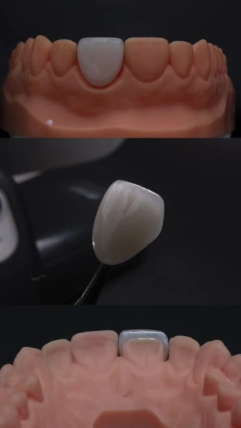Ultra-thin dental ceramic veneers on 3D models Stock Footage 315734277