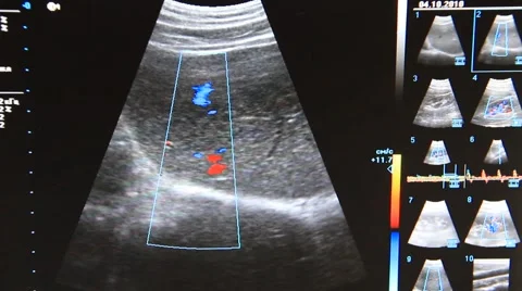 Ultrasonic examination Stock Footage