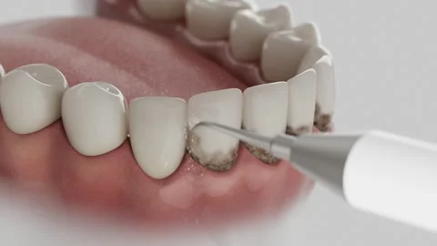 Ultrasonic removal 動画素材 313730903