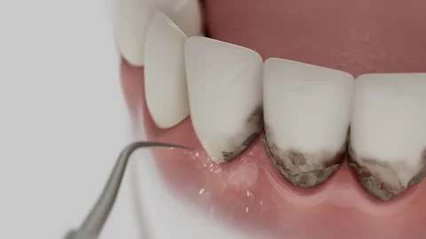 Ultrasonic removal Stock Footage 314964180