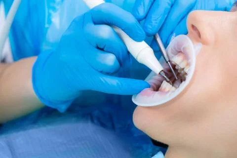 Ultrasonic teeth cleaning, close-up. Removal of tartar, plaque. Paradontitis, Stock Photos