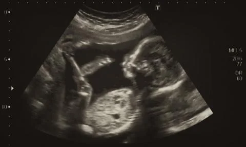 Ultrasonography Analysis of a 4th Month Fetus Stock Photos