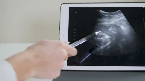 Ultrasonography of third trimester pregnancy Stock Footage 147339073